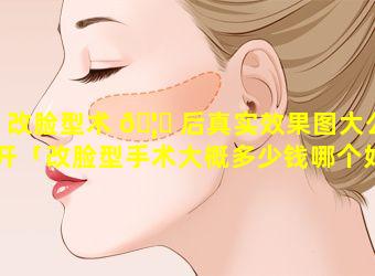 改脸型术 🦆 后真实效果图大公开「改脸型手术大概多少钱哪个好」